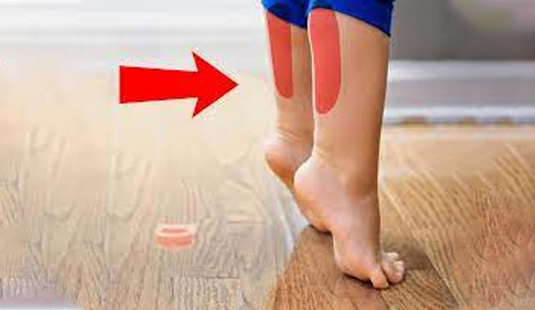 Sự nhạy cảm quá mức ở cơ bắp chân khiến trẻ không thoải mái khi di chuyển bằng cả bàn chân